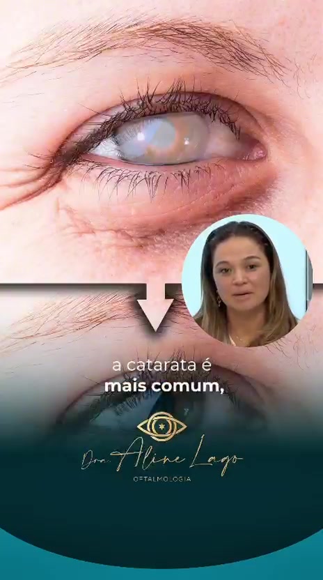 Dra. Aline Lago falando sobre os fatores que aceleram a catarata